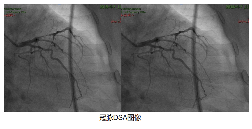 奕瑞科技：公司在X光探测器领域深耕多年，DSA用探测器已有IGZO、CMOS等技术路线的产品，并已实现销售