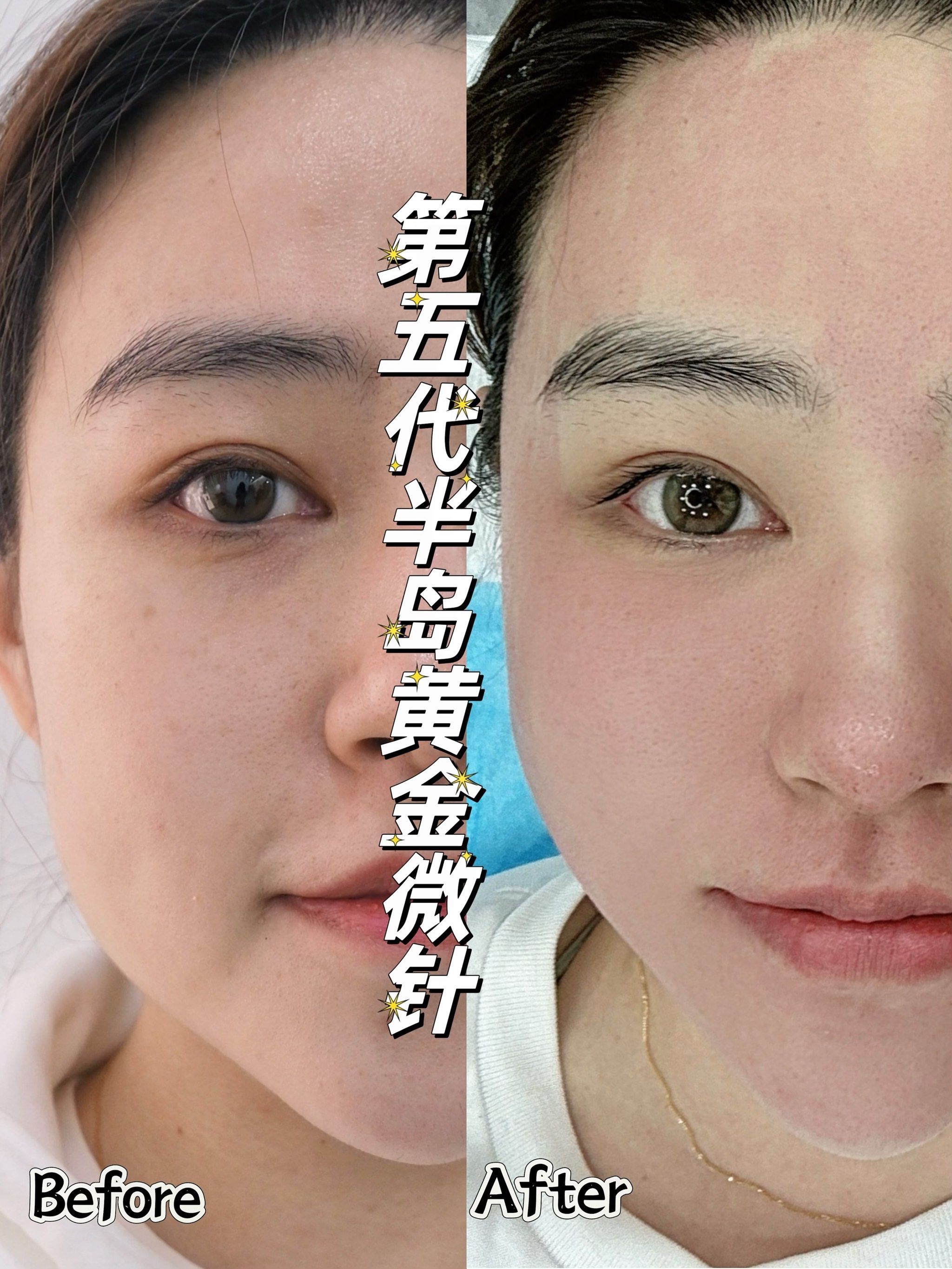 花5万元打的美容针，竟是修复骨缺损的骨科材料，约定注射的部位还没打就收费！美容所已被立案