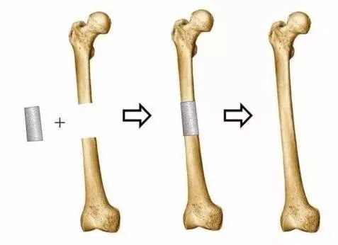 正海生物：钙硅生物陶瓷口腔骨修复材料获得医疗器械注册证
